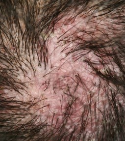 Atopichesky la dermatitis del año